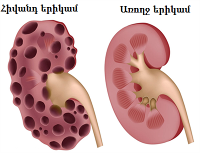 kidney-disease-medifee-w411.png
